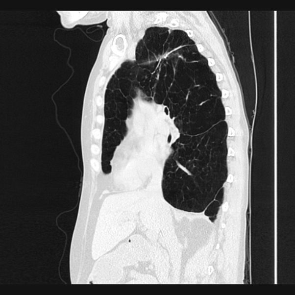 Centrilobular pulmonary emphysema (Radiopaedia 24495-24789 Sagittal lung window 35).jpg