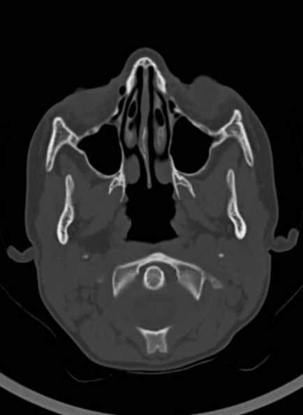 Cerebellar abscess (Radiopaedia 73727-84527 Axial bone window 15).jpg