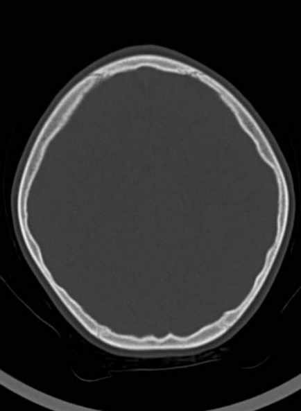 File:Cerebellar abscess (Radiopaedia 73727-84527 Axial bone window 50).jpg