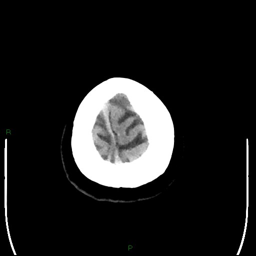 Cerebellar abscess (Radiopaedia 78135-90671 Axial non-contrast 106).jpg