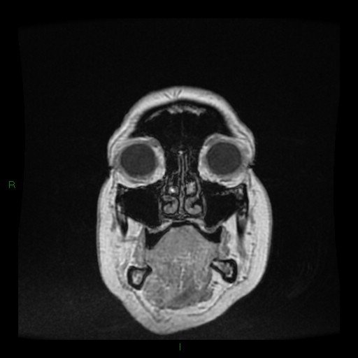 Cerebellar abscess (Radiopaedia 78135-90678 Coronal T1 C+ 10).jpg