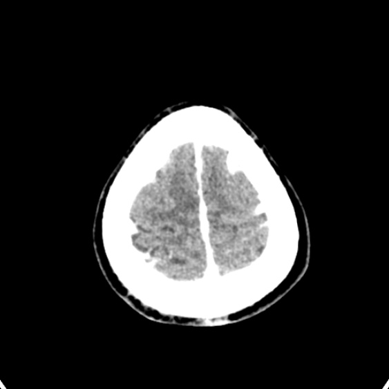 Cerebellar abscess secondary to mastoiditis (Radiopaedia 26284-26412 Axial C+ delayed 142).jpg