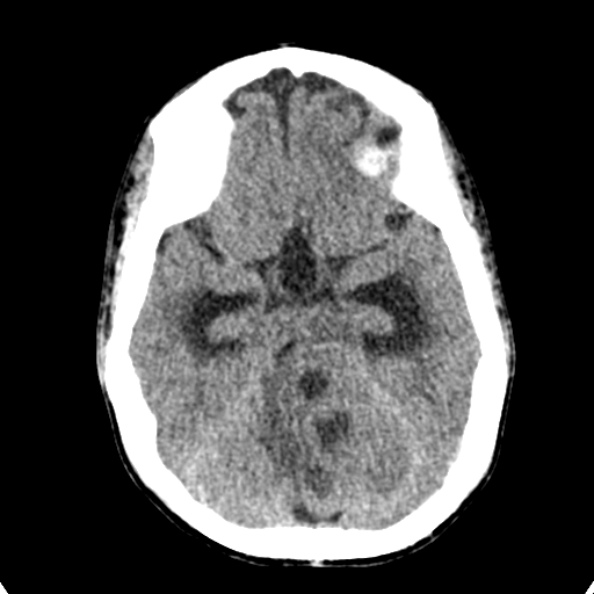 File:Cerebellar abscess secondary to mastoiditis (Radiopaedia 26284-26412 Axial non-contrast 56).jpg