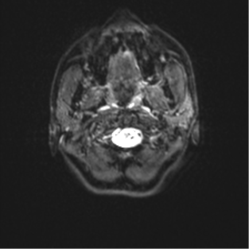 Cerebellar agenesis with hypoplastic pons (pontocerebellar hypoplasia) (Radiopaedia 57224-64138 Axial DWI 2).png
