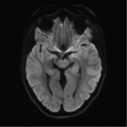Cerebellar agenesis with hypoplastic pons (pontocerebellar hypoplasia) (Radiopaedia 57224-64138 Axial DWI 53).png