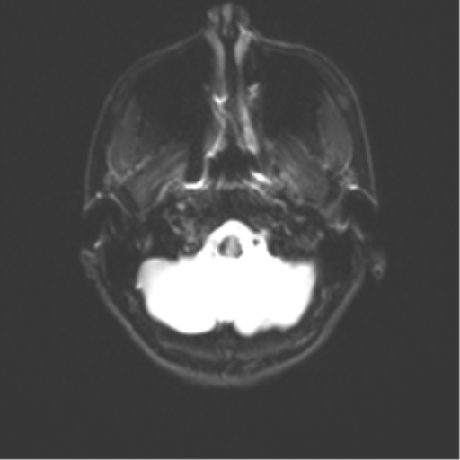 Cerebellar agenesis with hypoplastic pons (pontocerebellar hypoplasia) (Radiopaedia 57224-64138 Axial DWI 7).png
