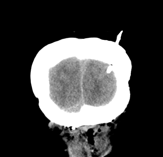 File:Cerebellar ependymoma complicated by post-operative subdural hematoma (Radiopaedia 83322-97737 Coronal non-contrast 35).png