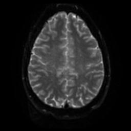 Cerebellar hemangioblastoma (Radiopaedia 29570-30077 Axial DWI 45).jpg