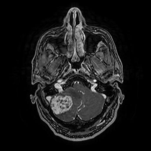 Cerebellar hemangioblastoma (Radiopaedia 88055-104622 Axial T1 C+ 42).jpg