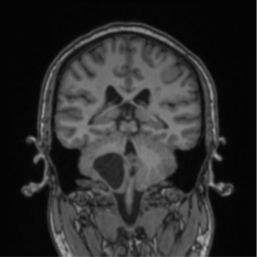 Cerebellar hemangioblastomas and pituitary adenoma (Radiopaedia 85490-101176 Coronal T1 39).png