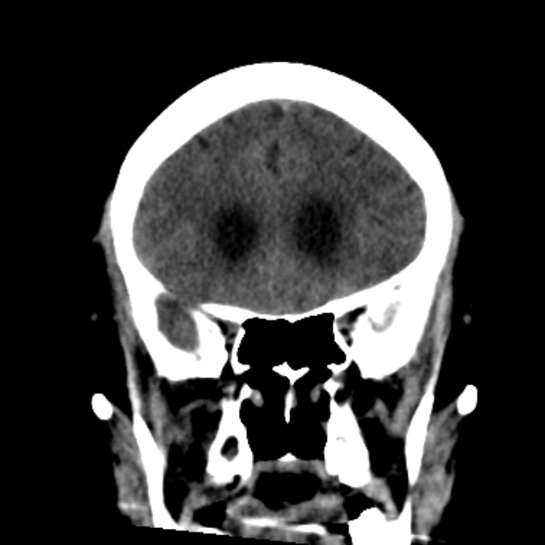 Cerebellar hemorrhage causing obstructive hydrocephalus (Radiopaedia 33989-35207 Coronal non-contrast 18).jpg