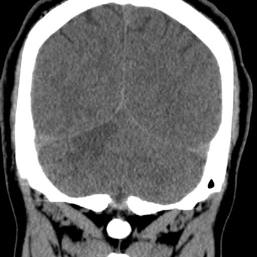 Cerebellar infarction (Radiopaedia 16625-16327 Coronal non-contrast 31).jpg