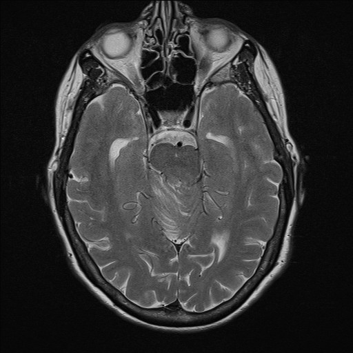 File:Cerebellar metastases (Radiopaedia 24038-24249 Axial T2 5).jpg