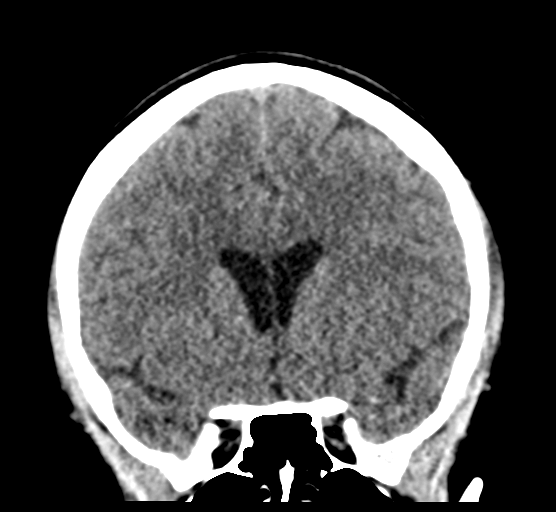 File:Cerebellar metastases - colorectal adenocarcinoma (Radiopaedia 40947-43652 Coronal non-contrast 38).png