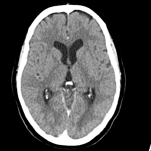 Cerebellar metastasis (Radiopaedia 54578-60812 Axial C+ 24).png