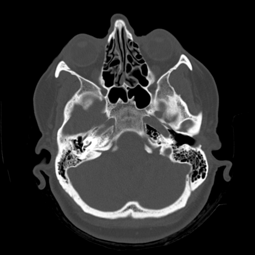 Cerebellar metastasis (cystic appearance) (Radiopaedia 41395-44258 Axial bone window 13).png