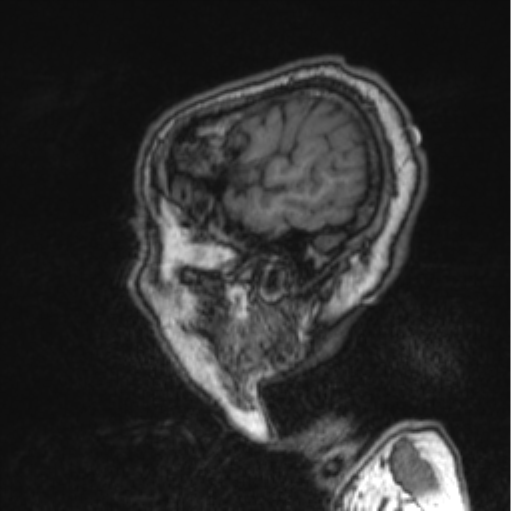 Cerebellar metastasis from lung adenocarcinoma (Radiopaedia 86690-102829 Sagittal T1 82).png