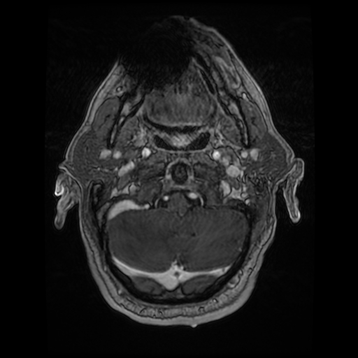 Cerebellar metastasis of pulmonary adenocarcinoma, cavernous venous malformation, and developmental venous anomaly (Radiopaedia 85827-101661 Axial T1 C+ 18).jpg