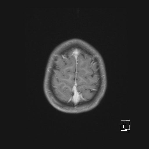 Cerebellar stroke (Radiopaedia 32202-33150 Axial T1 C+ 61).png