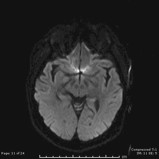 File:Cerebellar strokes due to intracranial giant cell arteritis (Radiopaedia 68799-81713 Axial DWI 11).jpg