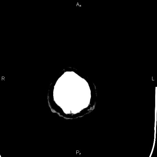 Cerebellopontine angle arachnoid cyst (Radiopaedia 85149-100704 Axial With contrast 55).jpg