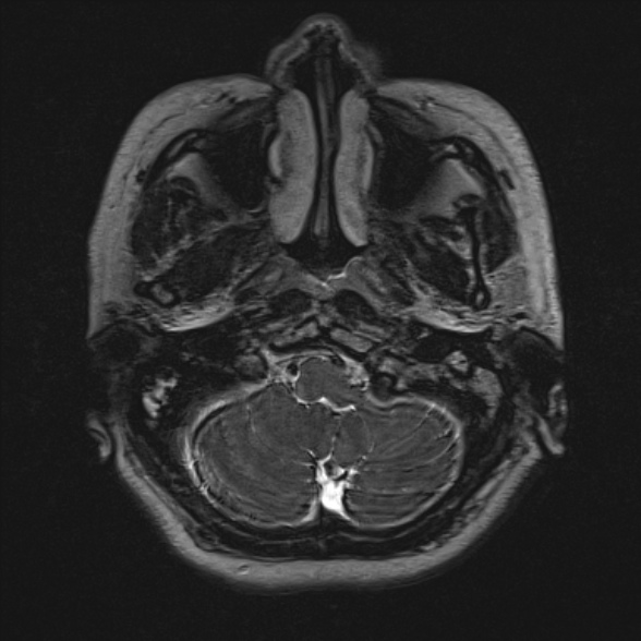 Cerebellopontine angle meningioma (Radiopaedia 53561-59591 Axial 3D volume T2 24).jpg