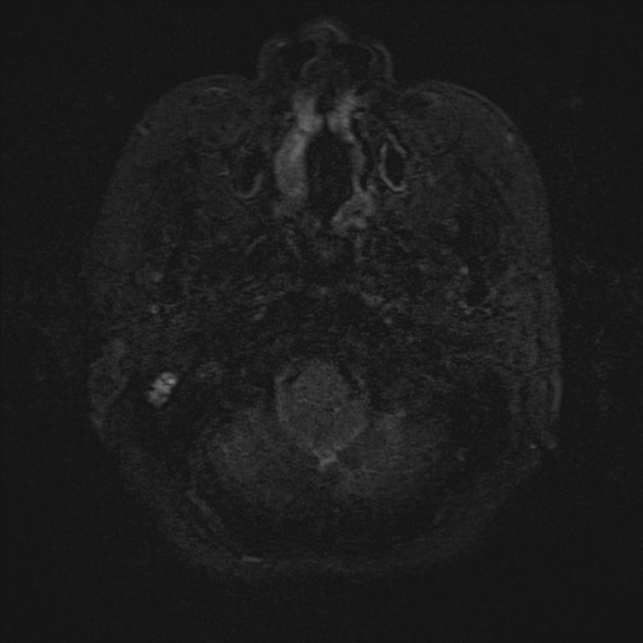 Cerebellopontine angle meningioma (Radiopaedia 53561-59591 Axial 3D volume T2 4).jpg