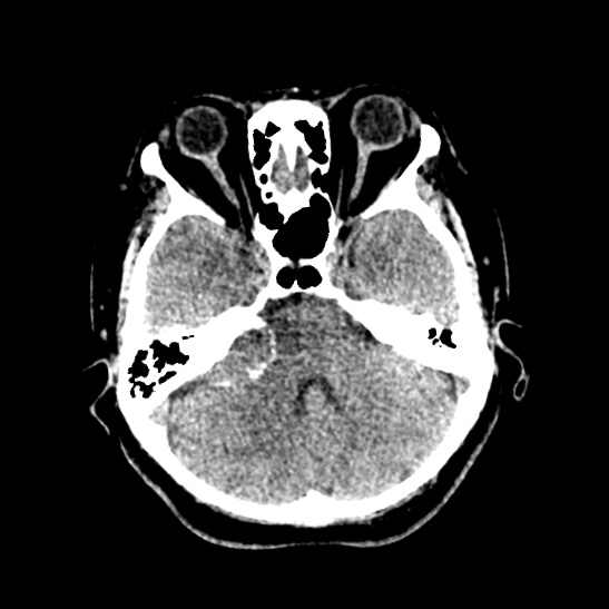 Cerebellopontine angle meningioma (Radiopaedia 53561-59592 Axial non-contrast 19).jpg