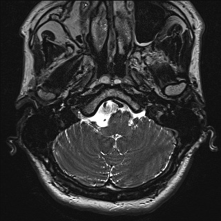 Cerebellopontine angle meningioma (Radiopaedia 72983-83680 Axial FIESTA 6).jpg