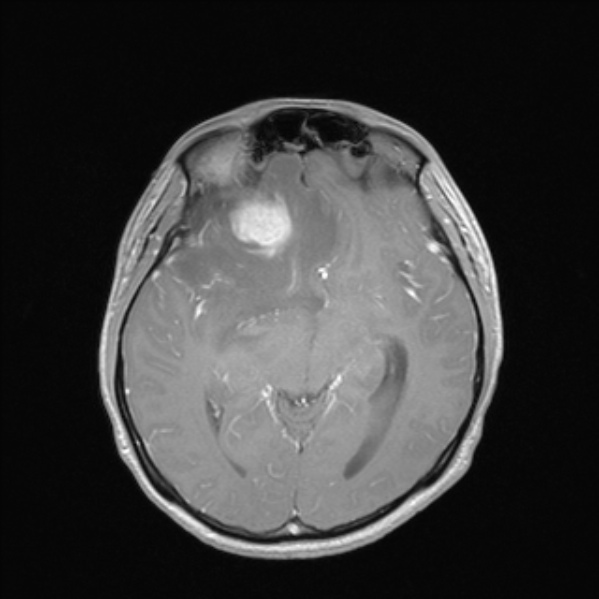 Cerebral abscess (Radiopaedia 24212-24478 Axial T1 C+ 29).jpg