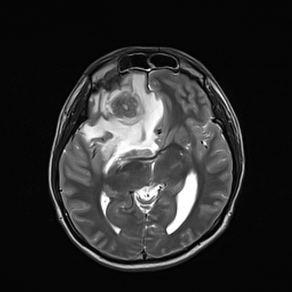 Cerebral abscess (Radiopaedia 24212-24478 Axial T2 30).jpg
