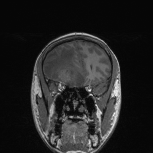 Cerebral abscess (Radiopaedia 24212-24478 Coronal T1 70).jpg