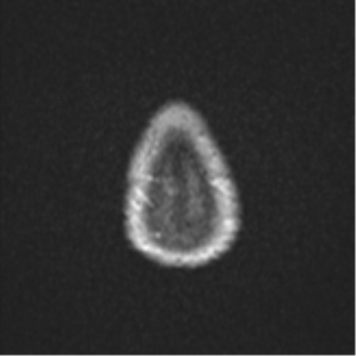 File:Cerebral abscess (Radiopaedia 60342-68009 Axial DWI 36).png