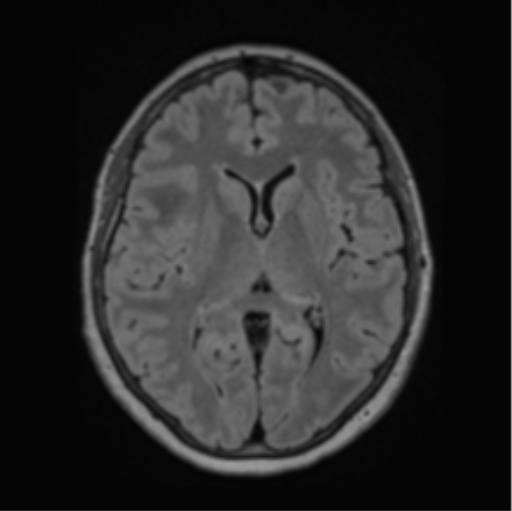 File:Cerebral abscess from pulmonary arteriovenous malformation (Radiopaedia 86275-102291 J 41).png