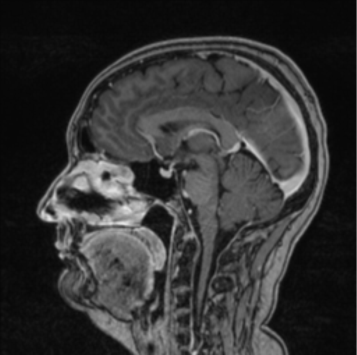 Cerebral abscess from pulmonary arteriovenous malformation (Radiopaedia 86275-102291 Sagittal T1 C+ 39).png