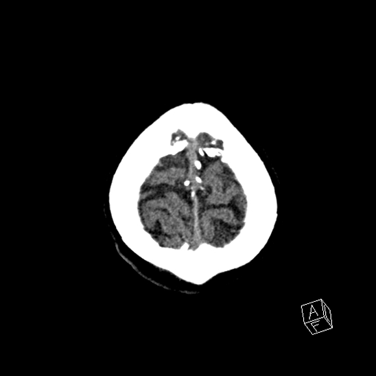 Cerebral abscess with ventriculitis (Radiopaedia 78965-91876 Axial non-contrast 46).jpg