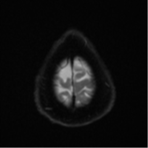 Cerebral abscesses- medically managed (Radiopaedia 45183-49179 Axial DWI 26).png