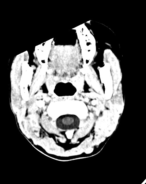 Cerebral abscesses (Radiopaedia 70458-80568 Axial Contrast 4).jpg