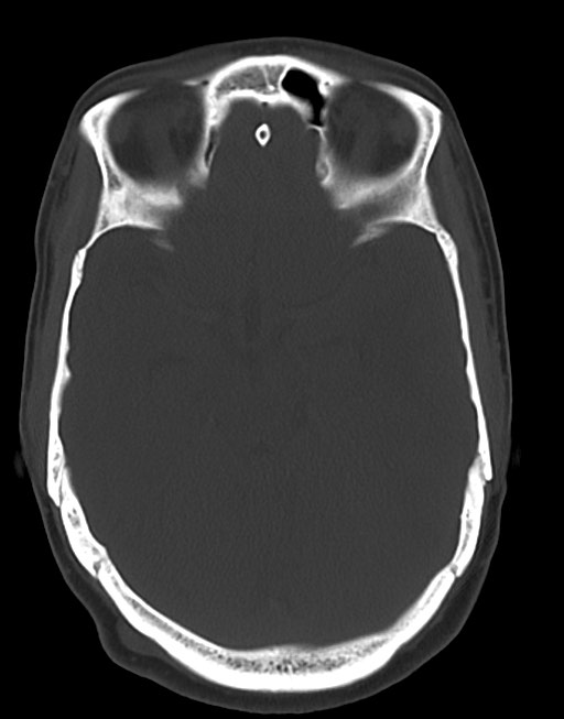 Cerebral abscesses (Radiopaedia 70458-80568 Axial bone window 25).jpg