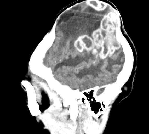 Cerebral abscesses (Radiopaedia 70458-80568 Sagittal Contrast 12).jpg