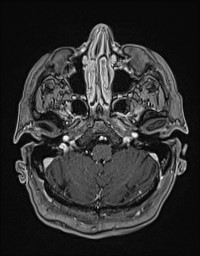 Cerebral amyloid angiopathy-related inflammation (Radiopaedia 58270-65377 Axial T1 C+ fat sat 16).jpg