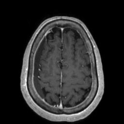 File:Cerebral amyloid angiopathy (Radiopaedia 29129-29518 Axial T1 C+ 119).jpg