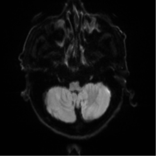 Cerebral amyloid angiopathy (Radiopaedia 46082-50433 Axial DWI 31).png