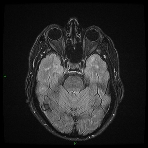 File:Cerebral amyloid angiopathy (Radiopaedia 77506-89664 Axial FLAIR 10).jpg