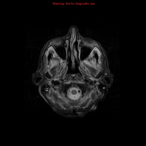 File:Cerebral and orbital tuberculomas (Radiopaedia 13308-13311 Axial T2 2).jpg