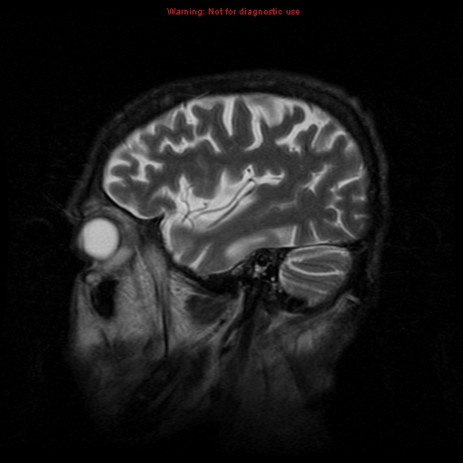 File:Cerebral and orbital tuberculomas (Radiopaedia 13308-13311 Sagittal T2 16).jpg