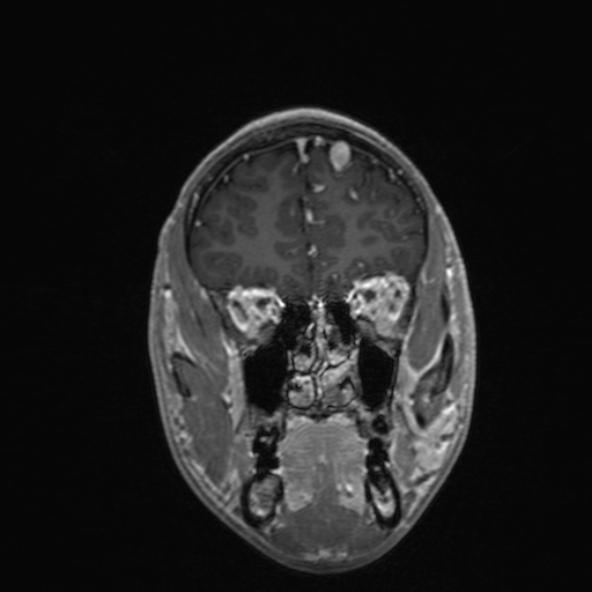 Cerebral arteriovenous malformation (Radiopaedia 30198-30813 F 16).jpg