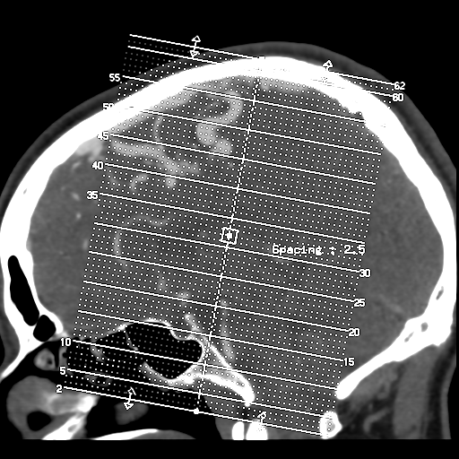 Cerebral arteriovenous malformation (Radiopaedia 39259-41505 AX CEREBRAL CTA 1).png