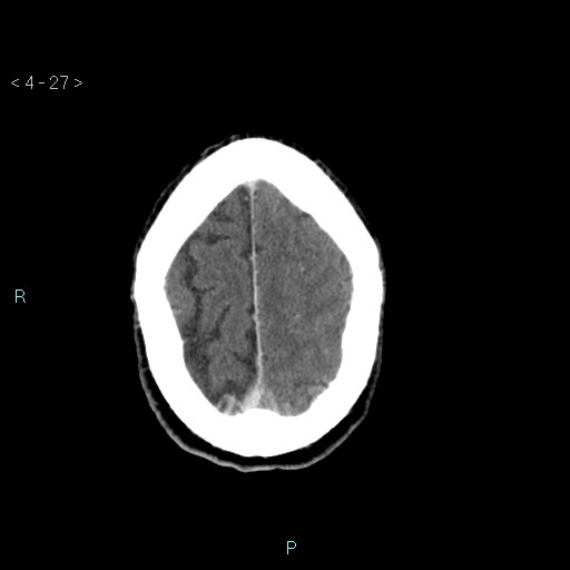 File:Cerebral arteriovenous malformation (Radiopaedia 40528-43125 Axial C+ delayed 27).jpg