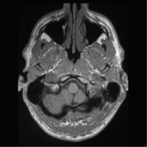 Cerebral arteriovenous malformation (Radiopaedia 55798-62372 Axial T1 2).png